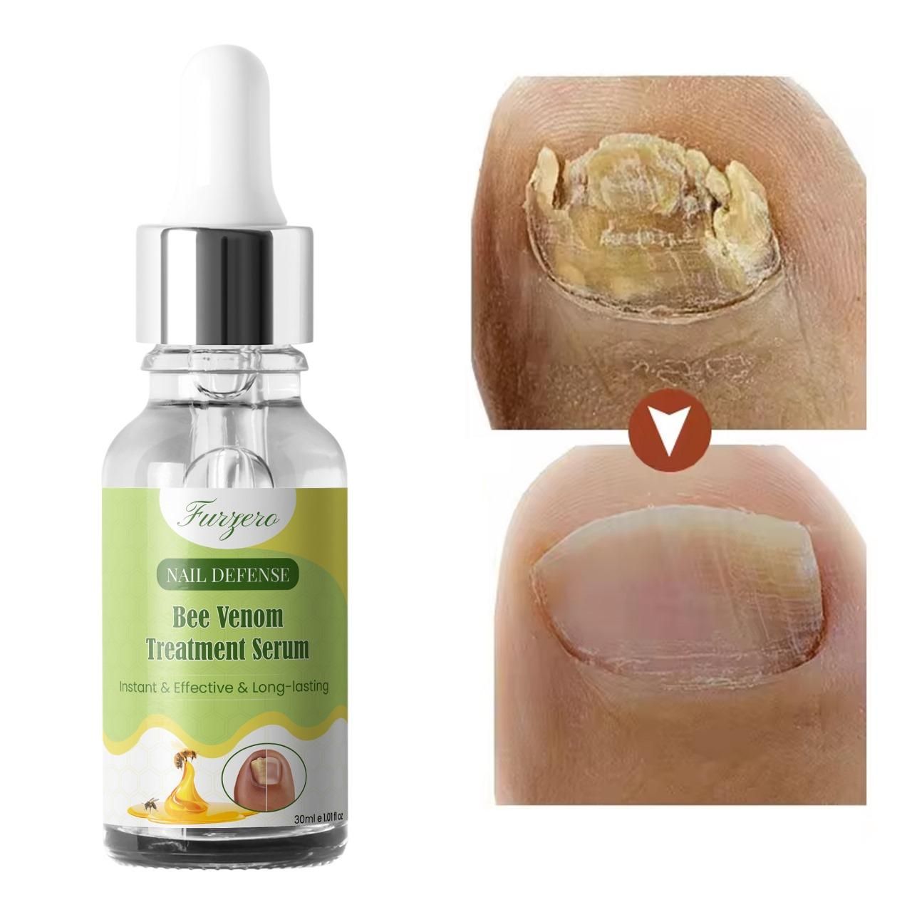 Furgero Nail Defense Bee Venom Treatment Serum 30ml(Pack Of 2)